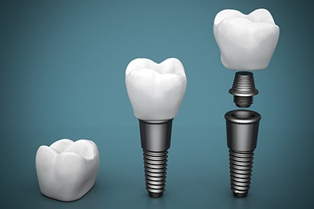 Dental Implants Hendersonville NC Hendersonville Family Dental