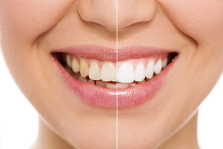 Teeth Whitening Hendersonville NC Hendersonville Familly Dental