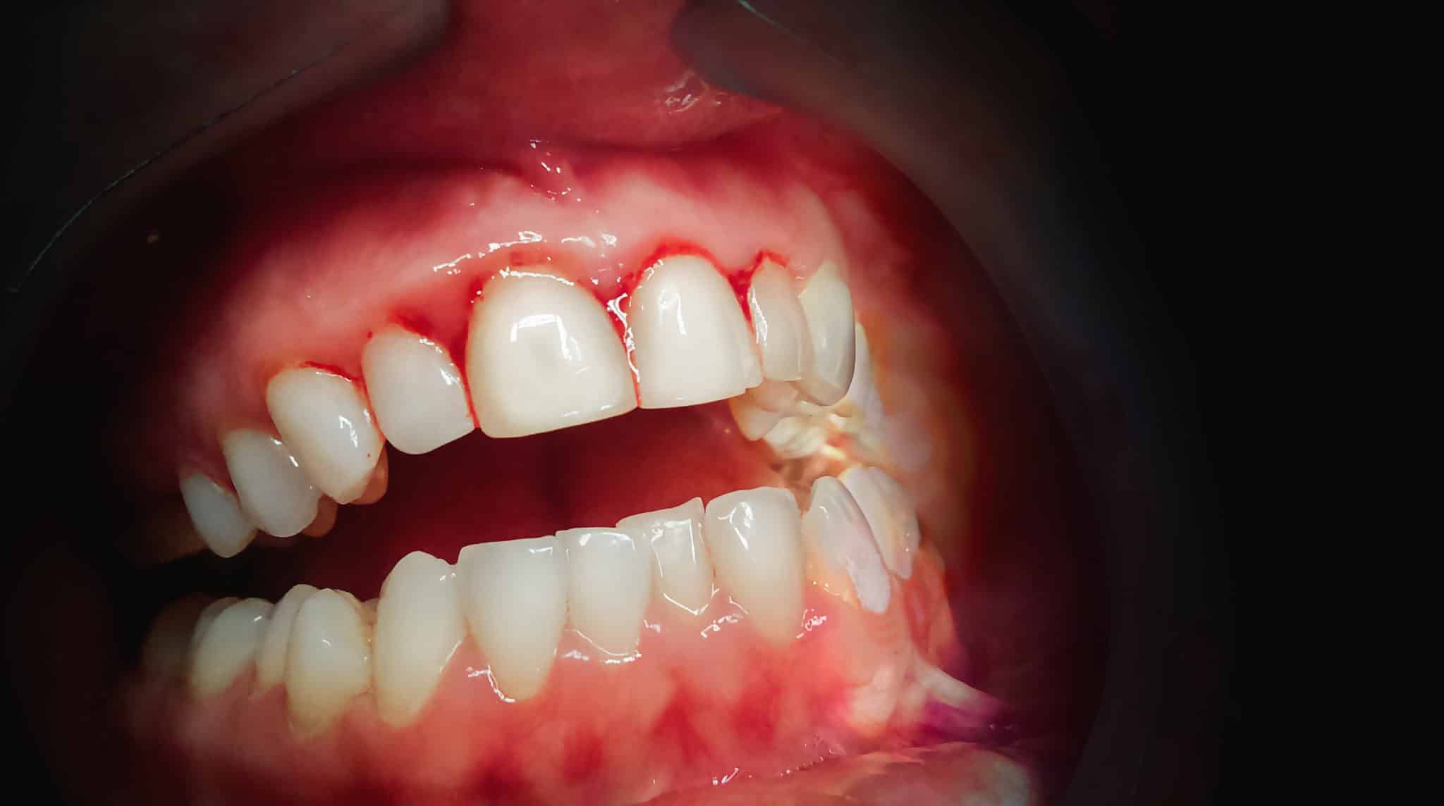gums bleeding after dentist visit