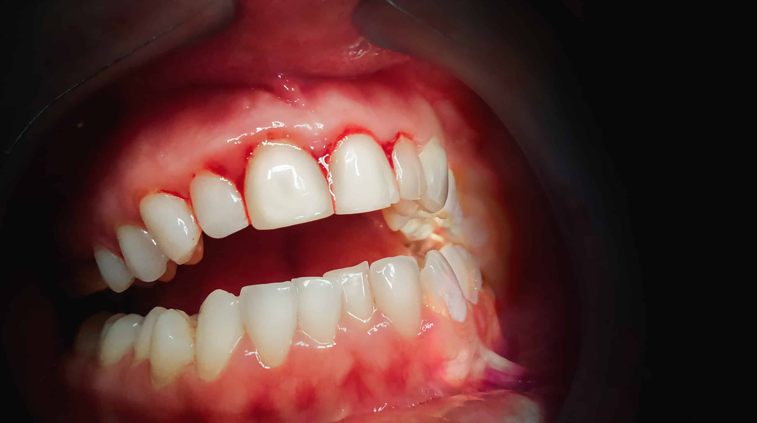 What do Bleeding Gums Mean? | Hendersonville Family Dental