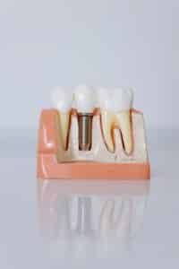 How to Take Care of Dental Implants How to Take Care of Dental Implants