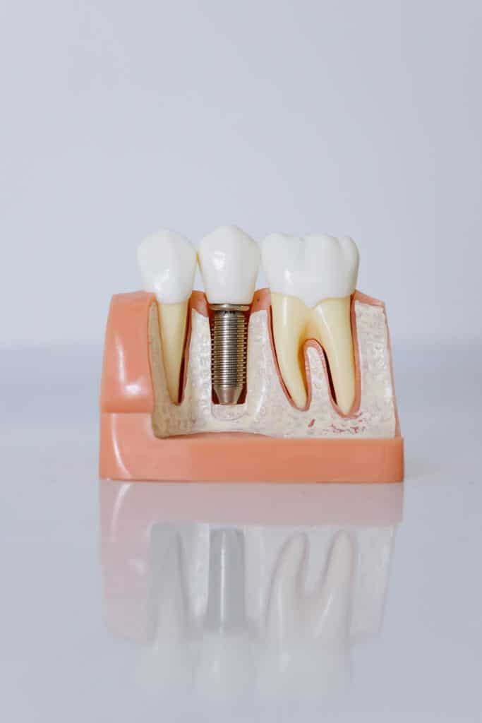 How To Take Care Of Dental Implants - Dental Implants 4 683x1024