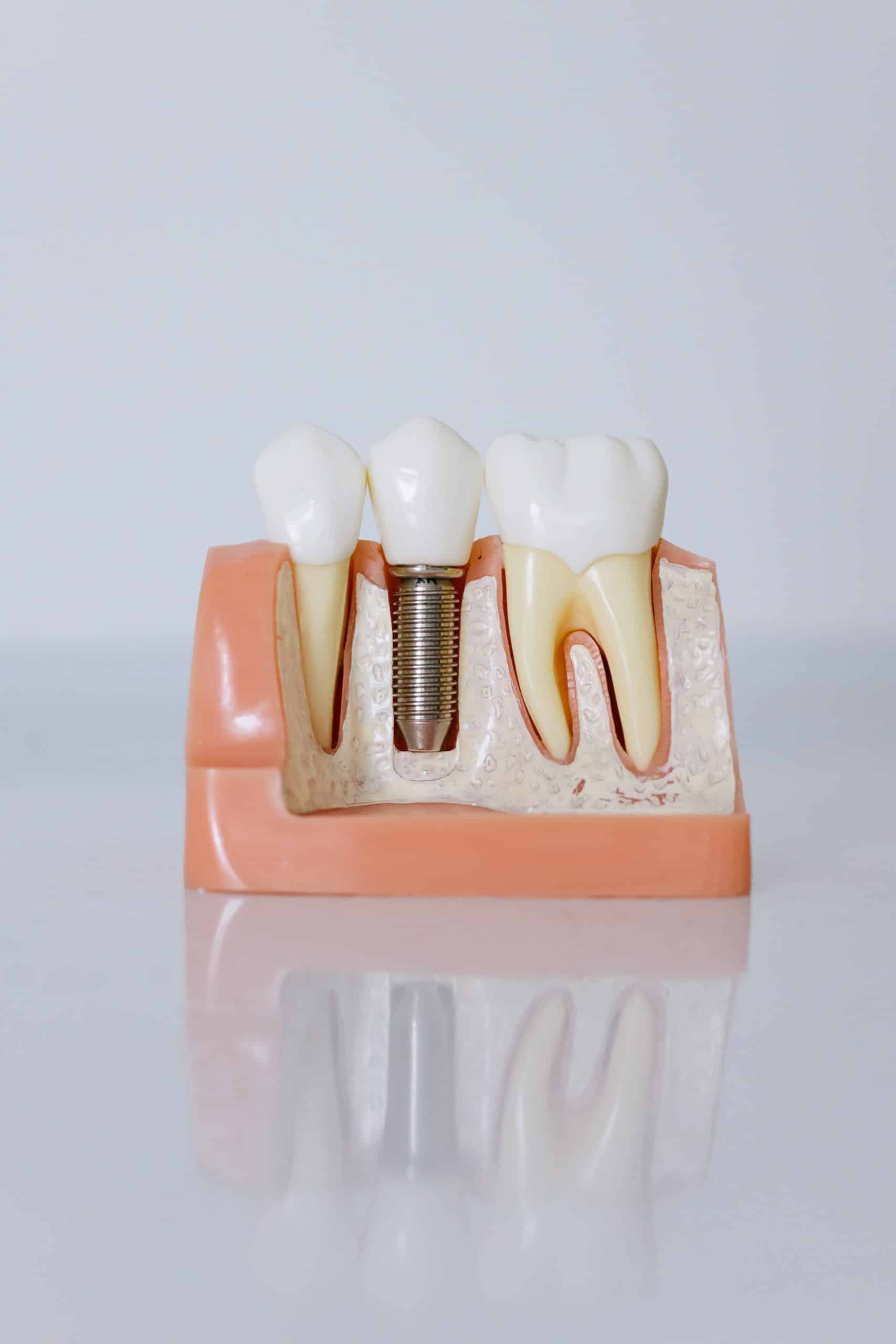How to Take Care of Dental Implants