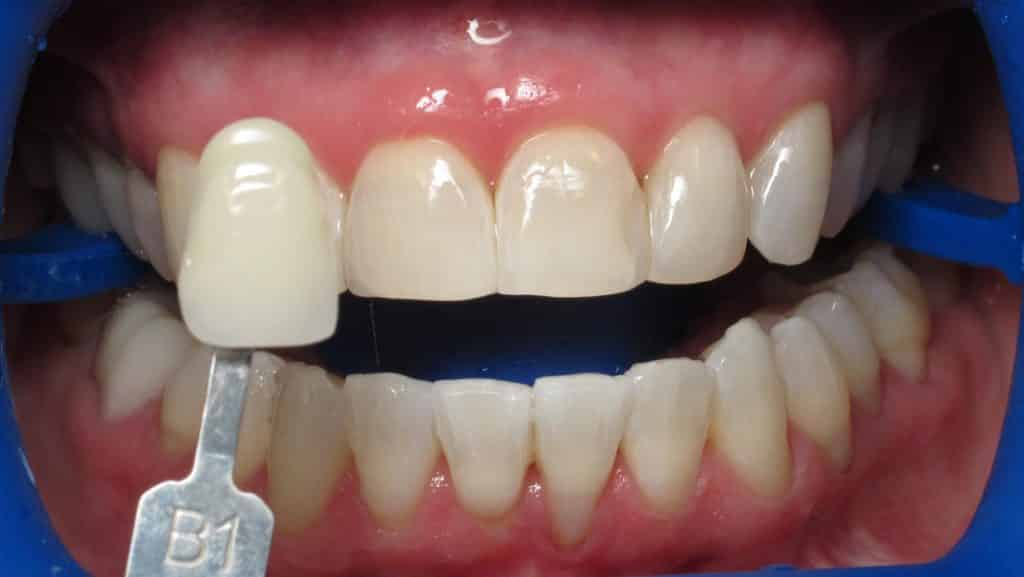Teeth Whitening teeth whitening hendersonville north carolina
