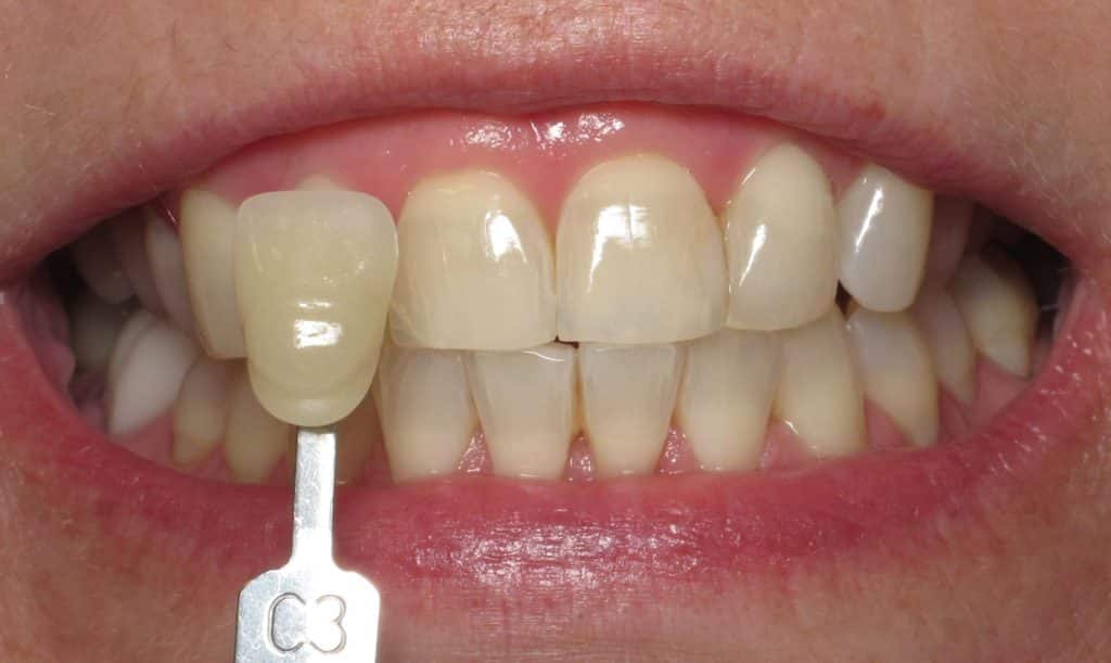 teeth whitening hendersonville nc