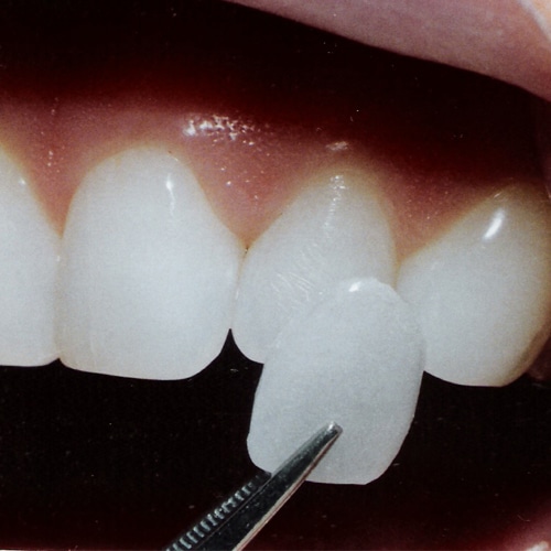 What You Need to Know Before Getting Veneers