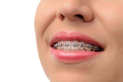 The Pros And Cons Of Clear Aligners Vs. Braces The Pros And Cons Of Clear Aligners Vs. Braces