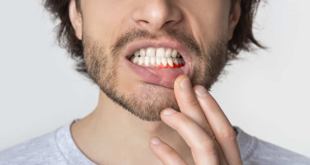 3 Effective Ways To Prevent Receding Gum Lines receding gum lines