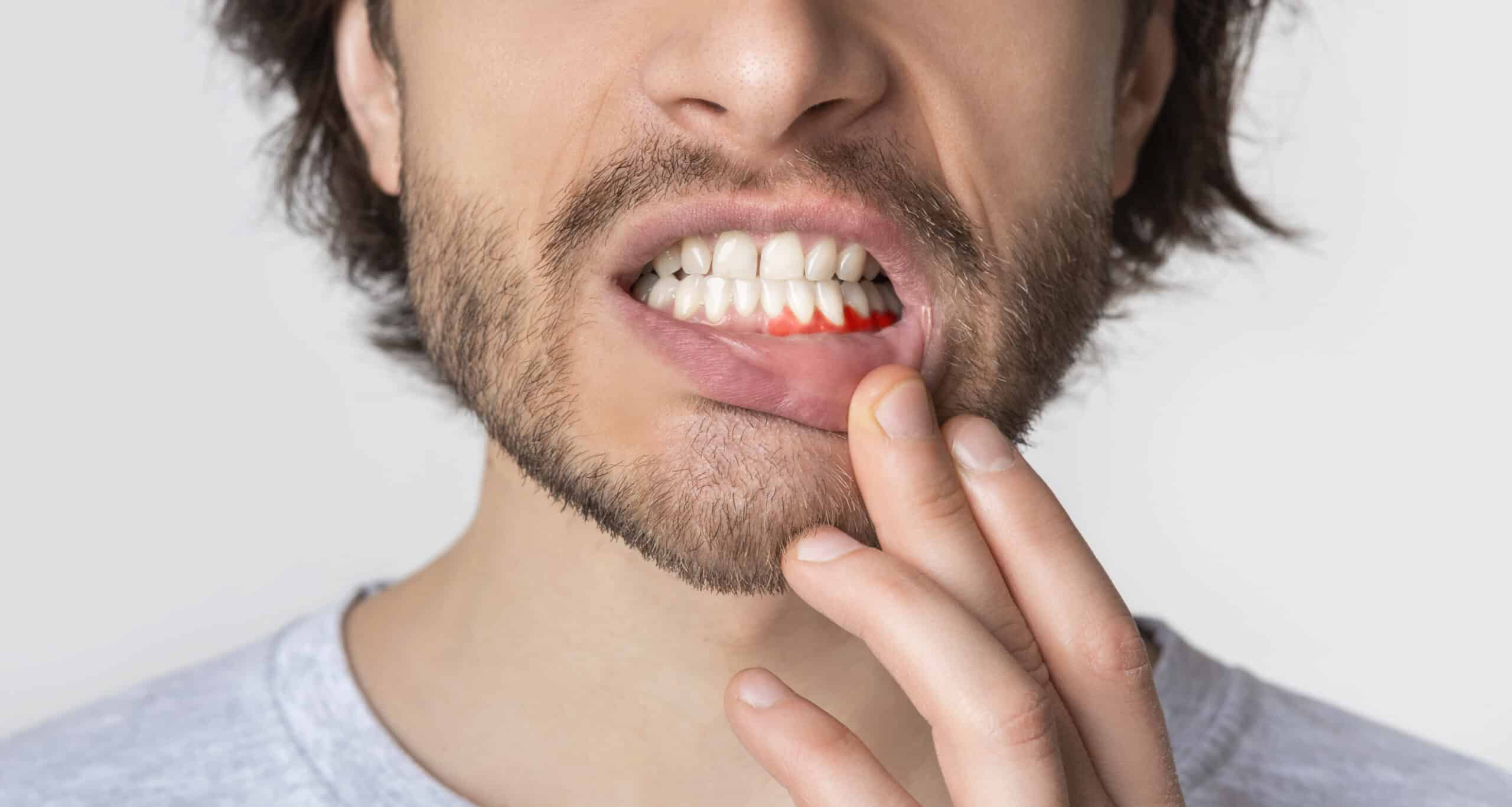 3 Effective Ways To Prevent Receding Gum Lines