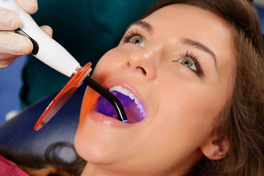 dental sealants