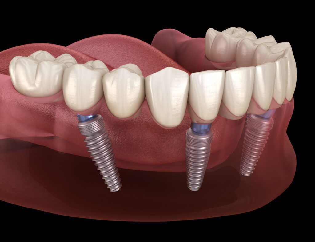 Get dental implants in Hendersonville, North Carolina