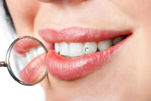 How Tooth Gems Can Damage Your Teeth