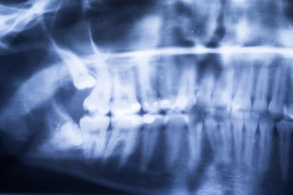 Impacted Wisdom Teeth: Understanding the Signs and When to Schedule Removal Impacted wisdom teeth in Hendersonville, NC